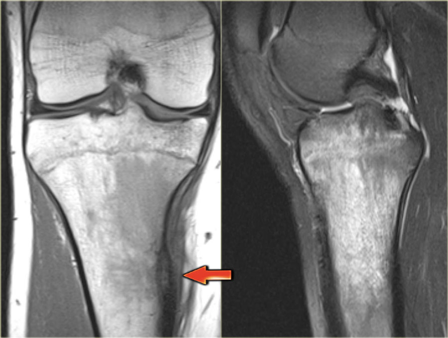 Отек костного мозга латеральных мыщелков. Опухоли большеберцовой кости остеома. Остеоид остеома надколенника. Остеоид-остеома бедренной кости.