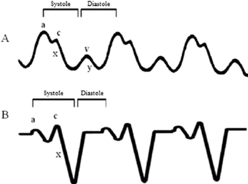 Cardiac Tamponade at emaze Presentation