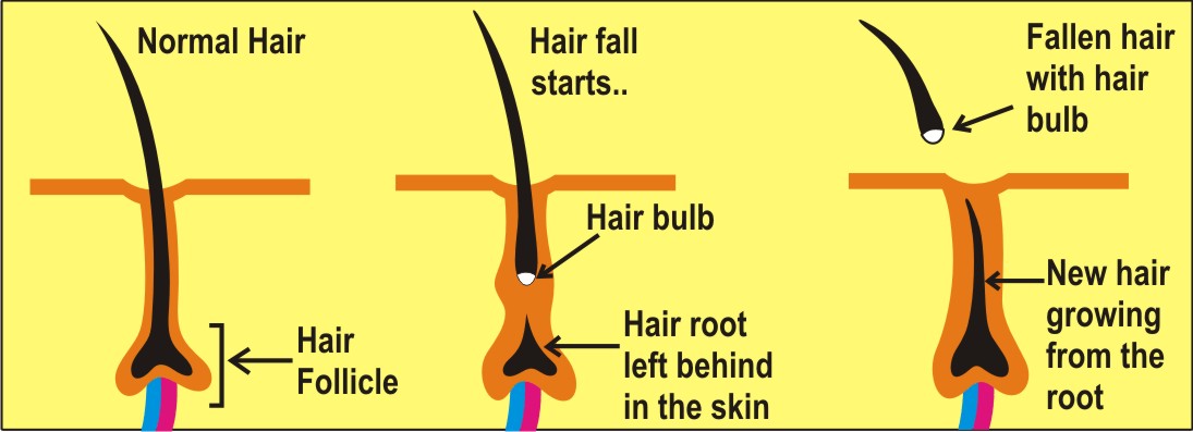 При удалении волоса луковица