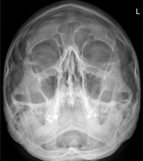 Facial Bones Xray tutorial on emaze