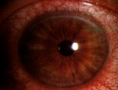 BACTERIAL CONJUNCTIVAL INFECTIONS.pptx on emaze