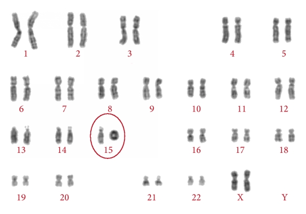 Хромосомы лучше видны. Синдром Ангельмана кариотип. Синдром Ангельмана 15 хромосома.