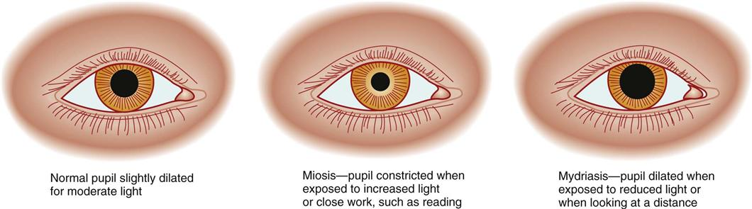 acute unilateral miotic pupil
