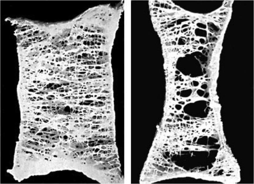Остеопороз фото костей