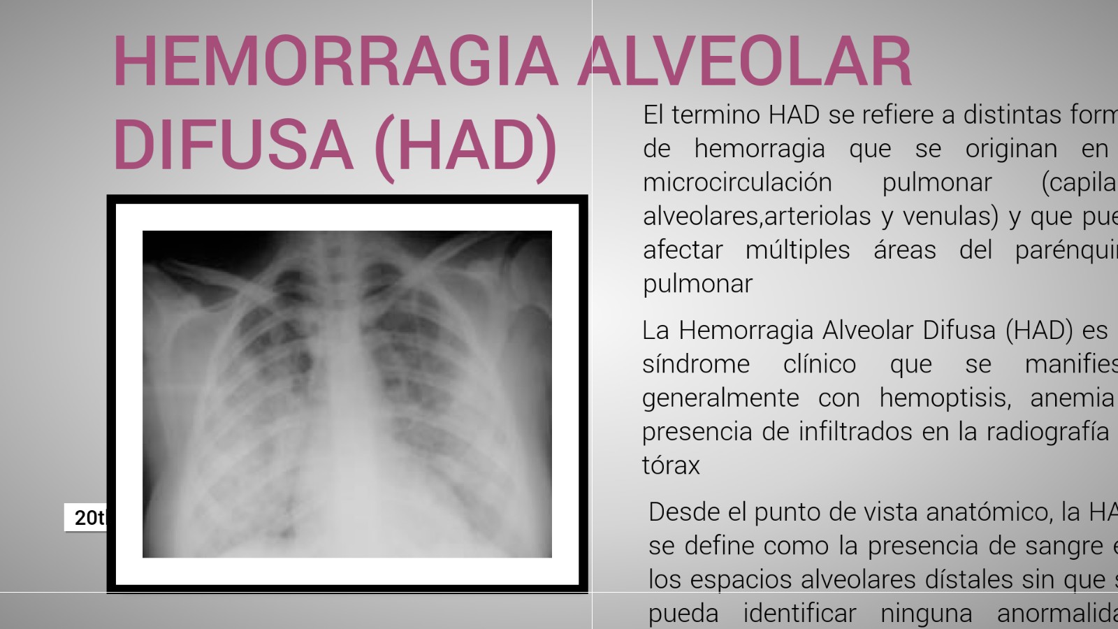 HEMORRAGIA ALVEOLAR DIFUSA (HAD) at emaze Presentation