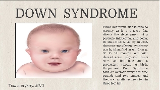 Down Syndro Syndrome At Emaze Presentation