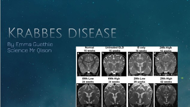 Krabbes disease at emaze Presentation