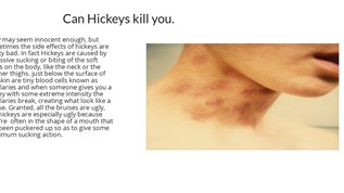 Can Hickeys kill at emaze Presentation